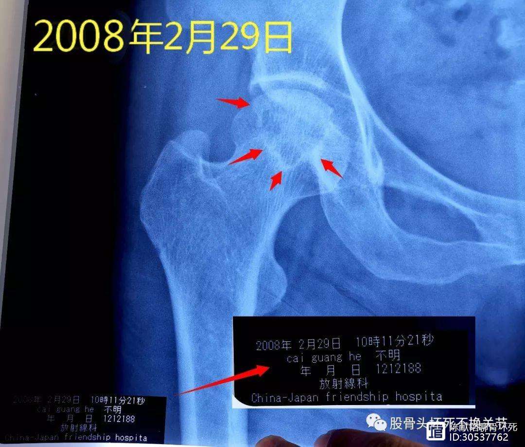 陇南人工骨头医保报销多少(人工骨头医保报销多少比例)