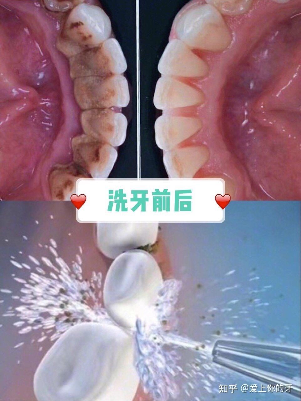 陇南洗牙可以用医保吗(洗牙可以用医保吗,报销比例多少)